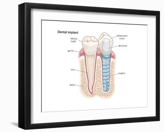 Dental Crown. Dentistry, Endodontics, Teeth, Tooth Damage, Oral Health, Health and Disease-Encyclopaedia Britannica-Framed Art Print