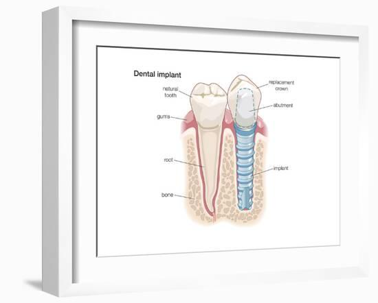 Dental Crown. Dentistry, Endodontics, Teeth, Tooth Damage, Oral Health, Health and Disease-Encyclopaedia Britannica-Framed Art Print