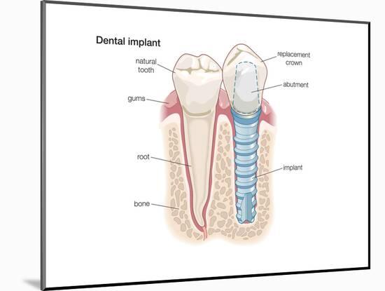 Dental Crown. Dentistry, Endodontics, Teeth, Tooth Damage, Oral Health, Health and Disease-Encyclopaedia Britannica-Mounted Art Print