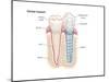 Dental Crown. Dentistry, Endodontics, Teeth, Tooth Damage, Oral Health, Health and Disease-Encyclopaedia Britannica-Mounted Art Print