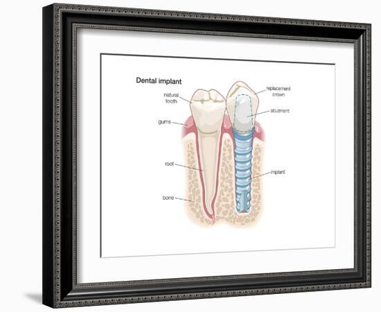 Dental Crown. Dentistry, Endodontics, Teeth, Tooth Damage, Oral Health, Health and Disease-Encyclopaedia Britannica-Framed Art Print