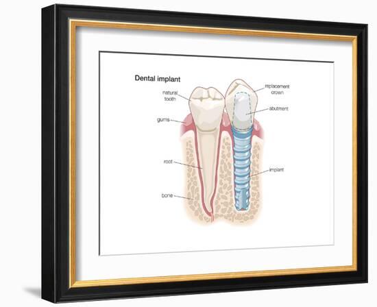 Dental Crown. Dentistry, Endodontics, Teeth, Tooth Damage, Oral Health, Health and Disease-Encyclopaedia Britannica-Framed Art Print