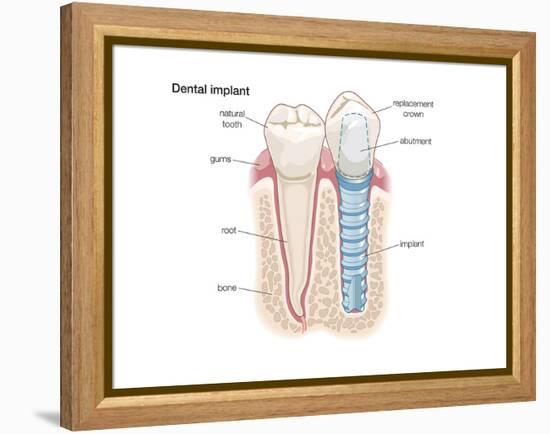 Dental Crown. Dentistry, Endodontics, Teeth, Tooth Damage, Oral Health, Health and Disease-Encyclopaedia Britannica-Framed Stretched Canvas