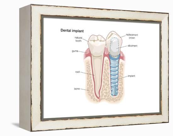 Dental Crown. Dentistry, Endodontics, Teeth, Tooth Damage, Oral Health, Health and Disease-Encyclopaedia Britannica-Framed Stretched Canvas