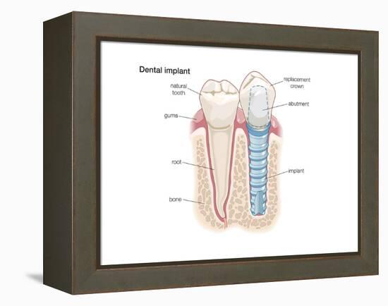 Dental Crown. Dentistry, Endodontics, Teeth, Tooth Damage, Oral Health, Health and Disease-Encyclopaedia Britannica-Framed Stretched Canvas