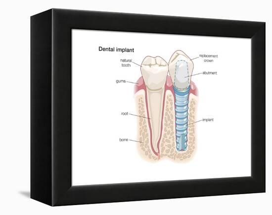 Dental Crown. Dentistry, Endodontics, Teeth, Tooth Damage, Oral Health, Health and Disease-Encyclopaedia Britannica-Framed Stretched Canvas