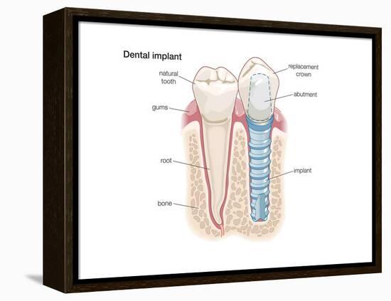 Dental Crown. Dentistry, Endodontics, Teeth, Tooth Damage, Oral Health, Health and Disease-Encyclopaedia Britannica-Framed Stretched Canvas