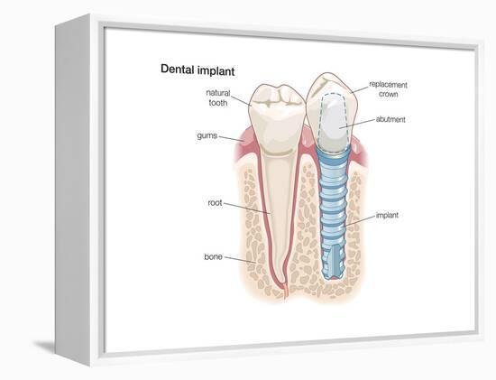 Dental Crown. Dentistry, Endodontics, Teeth, Tooth Damage, Oral Health, Health and Disease-Encyclopaedia Britannica-Framed Stretched Canvas