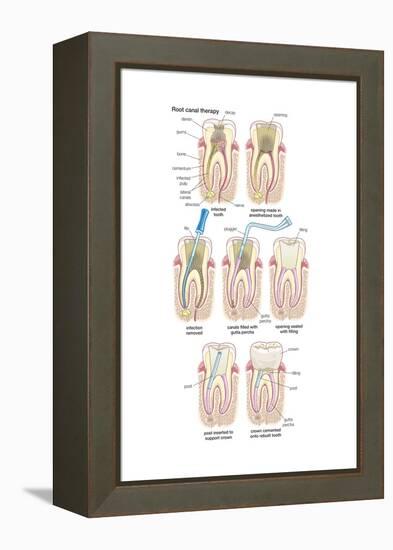 Dental Implant. Dentistry, Endodontics, Teeth, Tooth Damage, Oral Health, Health and Disease-Encyclopaedia Britannica-Framed Stretched Canvas