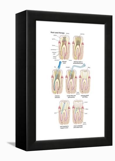 Dental Implant. Dentistry, Endodontics, Teeth, Tooth Damage, Oral Health, Health and Disease-Encyclopaedia Britannica-Framed Stretched Canvas