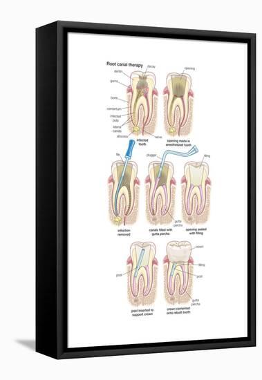 Dental Implant. Dentistry, Endodontics, Teeth, Tooth Damage, Oral Health, Health and Disease-Encyclopaedia Britannica-Framed Stretched Canvas