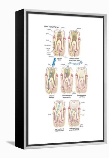 Dental Implant. Dentistry, Endodontics, Teeth, Tooth Damage, Oral Health, Health and Disease-Encyclopaedia Britannica-Framed Stretched Canvas