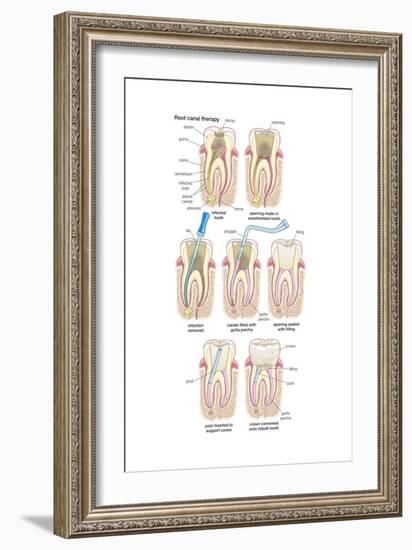 Dental Implant. Dentistry, Endodontics, Teeth, Tooth Damage, Oral Health, Health and Disease-Encyclopaedia Britannica-Framed Art Print