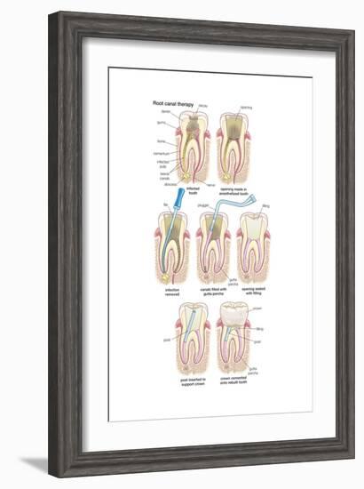 Dental Implant. Dentistry, Endodontics, Teeth, Tooth Damage, Oral Health, Health and Disease-Encyclopaedia Britannica-Framed Art Print