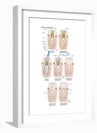 Dental Implant. Dentistry, Endodontics, Teeth, Tooth Damage, Oral Health, Health and Disease-Encyclopaedia Britannica-Framed Art Print