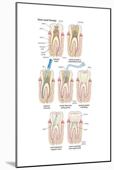 Dental Implant. Dentistry, Endodontics, Teeth, Tooth Damage, Oral Health, Health and Disease-Encyclopaedia Britannica-Mounted Art Print