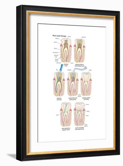 Dental Implant. Dentistry, Endodontics, Teeth, Tooth Damage, Oral Health, Health and Disease-Encyclopaedia Britannica-Framed Art Print