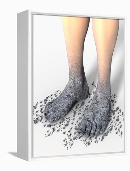 Diabetes-related Foot Problems, Artwork-David Mack-Framed Premier Image Canvas