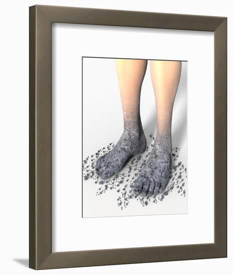 Diabetes-related Foot Problems, Artwork-David Mack-Framed Premium Photographic Print