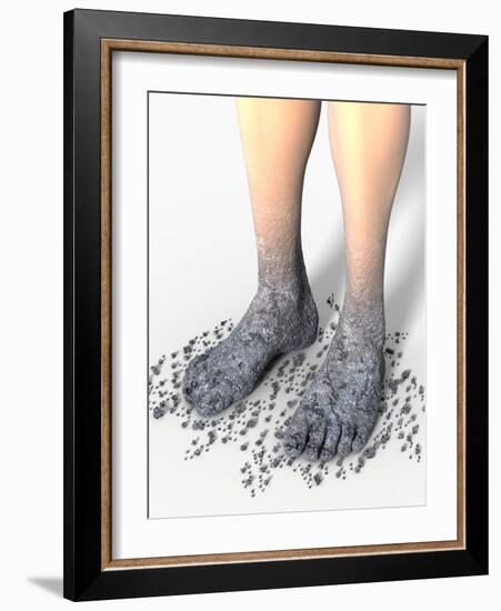 Diabetes-related Foot Problems, Artwork-David Mack-Framed Photographic Print