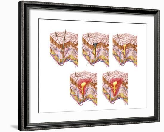 Different Types of Acne, Non-Inflammatory and Inflammatory-null-Framed Art Print