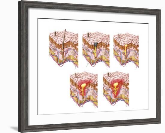 Different Types of Acne, Non-Inflammatory and Inflammatory-null-Framed Art Print