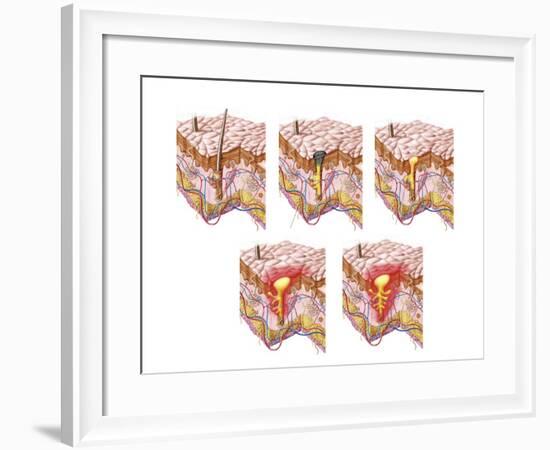 Different Types of Acne, Non-Inflammatory and Inflammatory-null-Framed Art Print