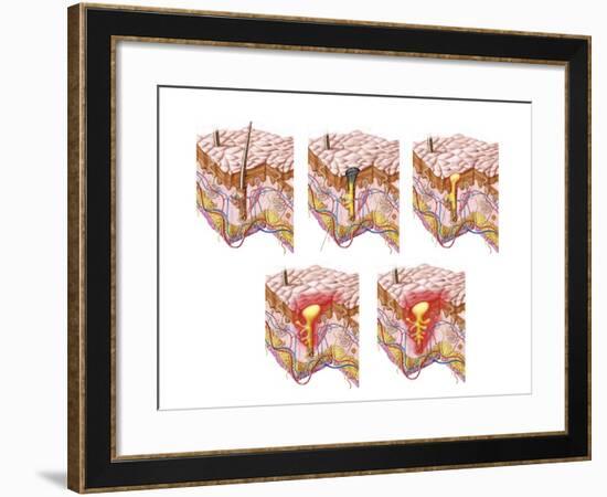 Different Types of Acne, Non-Inflammatory and Inflammatory-null-Framed Art Print