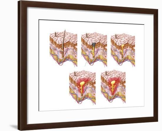 Different Types of Acne, Non-Inflammatory and Inflammatory-null-Framed Art Print