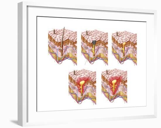 Different Types of Acne, Non-Inflammatory and Inflammatory-null-Framed Art Print