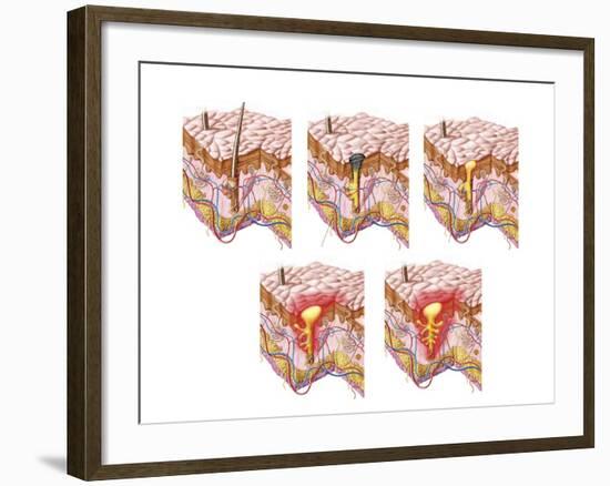 Different Types of Acne, Non-Inflammatory and Inflammatory-null-Framed Art Print