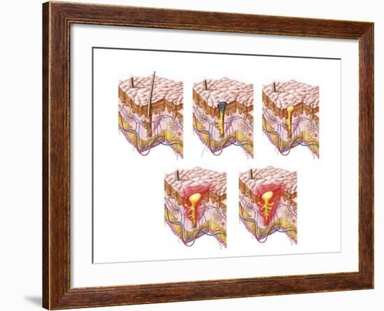 Different Types of Acne, Non-Inflammatory and Inflammatory-null-Framed Art Print