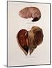 Diseased Livers, Hepatitis, Illustration, 1897-Science Source-Mounted Giclee Print