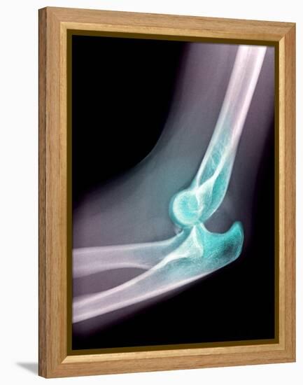 Dislocated Elbow, X-ray-Du Cane Medical-Framed Premier Image Canvas