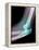 Dislocated Elbow, X-ray-Du Cane Medical-Framed Premier Image Canvas