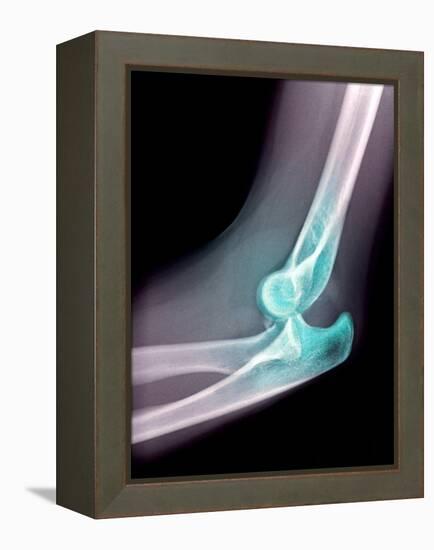 Dislocated Elbow, X-ray-Du Cane Medical-Framed Premier Image Canvas