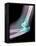 Dislocated Elbow, X-ray-Du Cane Medical-Framed Premier Image Canvas