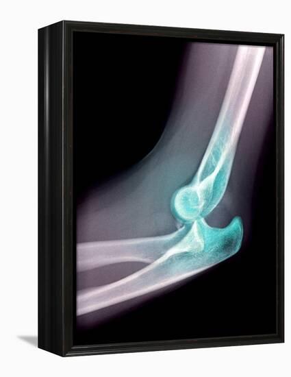 Dislocated Elbow, X-ray-Du Cane Medical-Framed Premier Image Canvas