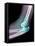 Dislocated Elbow, X-ray-Du Cane Medical-Framed Premier Image Canvas