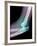 Dislocated Elbow, X-ray-Du Cane Medical-Framed Photographic Print