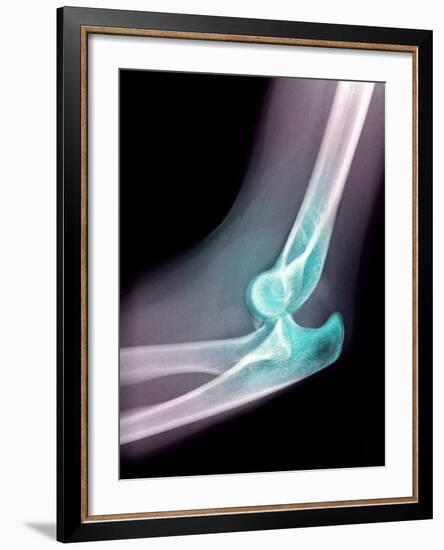 Dislocated Elbow, X-ray-Du Cane Medical-Framed Photographic Print