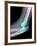 Dislocated Elbow, X-ray-Du Cane Medical-Framed Photographic Print