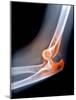 Dislocated Elbow, X-ray-Du Cane Medical-Mounted Photographic Print