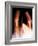 Dislocated Finger Joint, X-ray-ZEPHYR-Framed Photographic Print