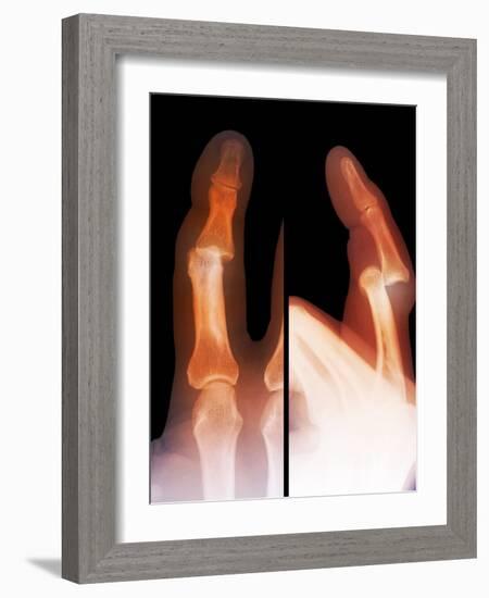 Dislocated Finger Joint, X-ray-ZEPHYR-Framed Photographic Print