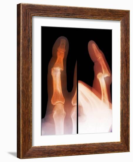 Dislocated Finger Joint, X-ray-ZEPHYR-Framed Photographic Print