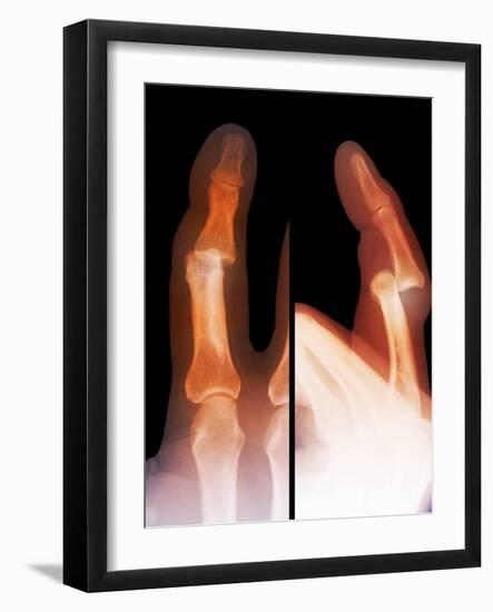 Dislocated Finger Joint, X-ray-ZEPHYR-Framed Photographic Print