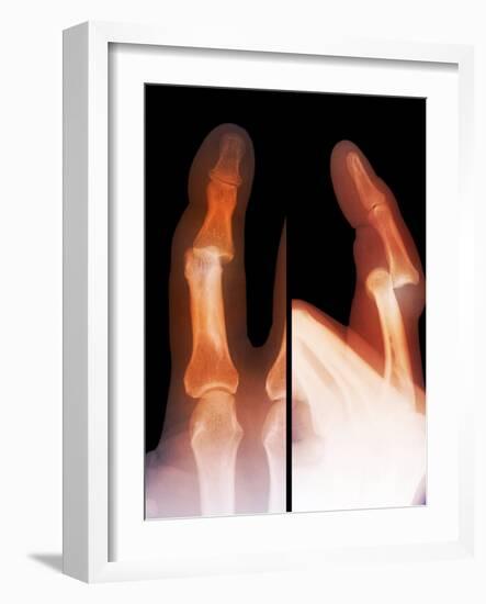 Dislocated Finger Joint, X-ray-ZEPHYR-Framed Photographic Print