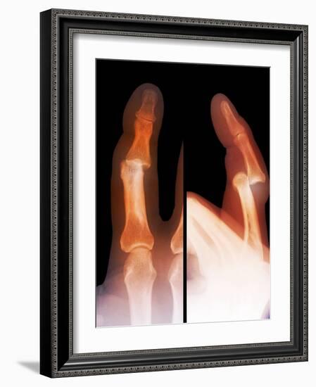 Dislocated Finger Joint, X-ray-ZEPHYR-Framed Photographic Print