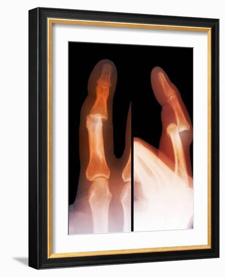 Dislocated Finger Joint, X-ray-ZEPHYR-Framed Photographic Print